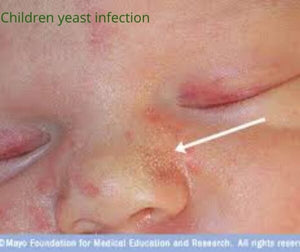 Yeast Infection: Causes, Symptoms, Diagnostics And Treatment