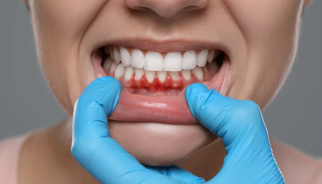 How far can gums recede before teeth fall out?