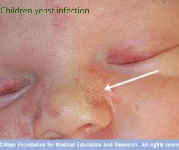 Yeast Infection: Causes, Symptoms, Diagnostics And Treatment