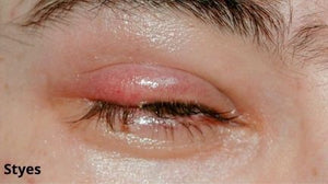 Styes