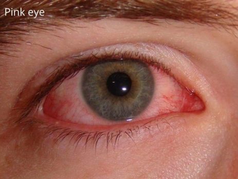 Pink Eye