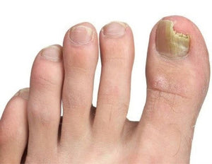 Nail Fungus