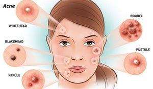 Acne
