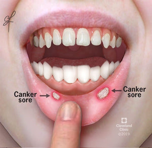 Canker Sores Reasons And Treatment