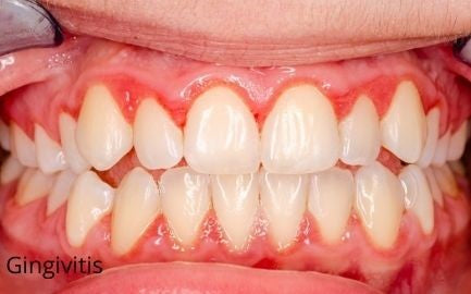 Gingivitis