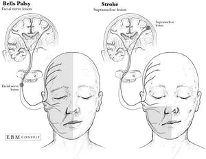 Discerning Facts About Bell’s Palsy Vs Stroke