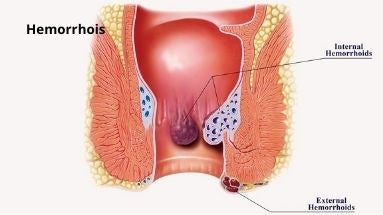 Haemorrhoids
