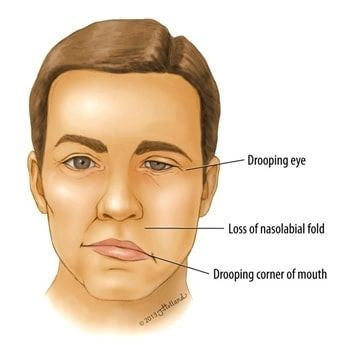 5 Essential Oils For Bell’s Palsy; Quick Relief And Fast Recovery