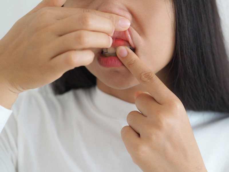 How to Get Rid of Bumps on Your Gums