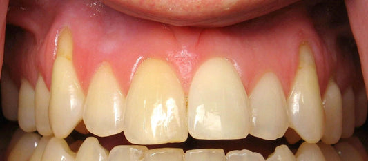 How to Treat Receding Gums: A Guide to Restoring Your Gum Health
