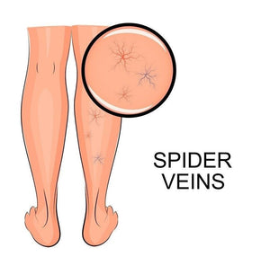 Spider Veins