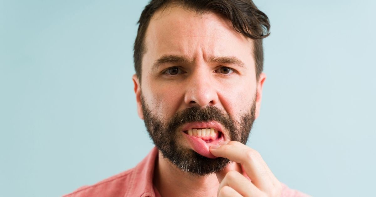 What does early gingivitis look like