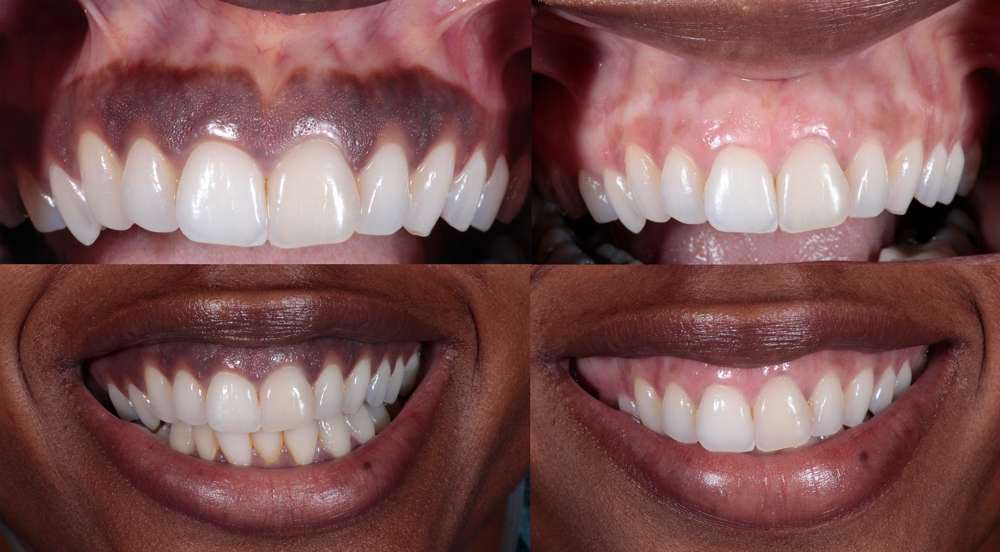 Is it normal to have purple gums?