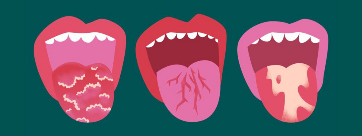 Can psoriasis affect your gums?