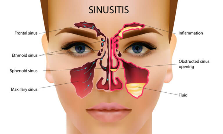 Can a Sinus Infection Cause Swollen Gums: Learn the Truth!