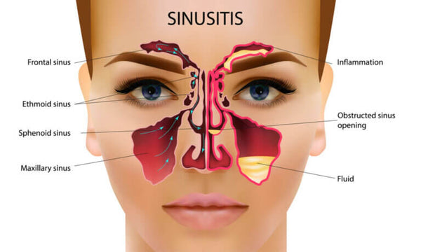 Can a Sinus Infection Cause Swollen Gums: Learn the Truth!