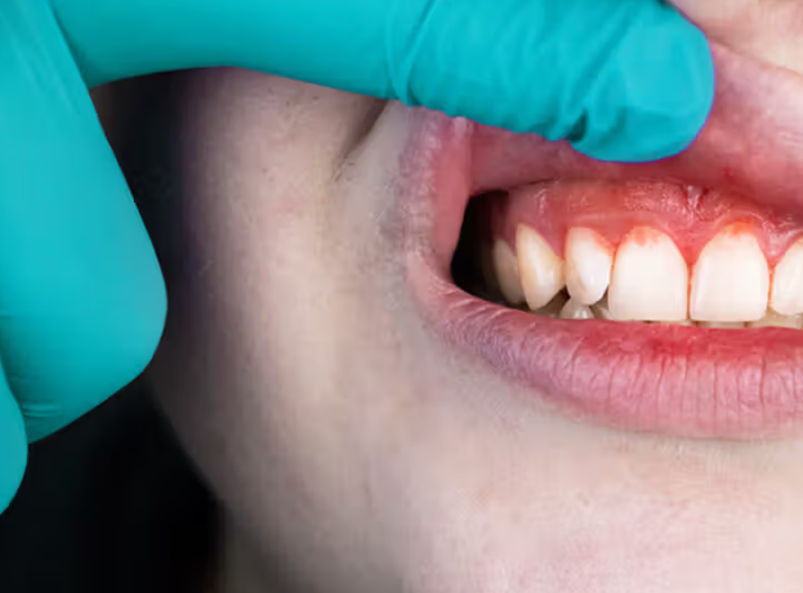 Why Is A Piece Of My Gum Hanging: Learn the Reasons!