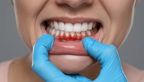 How far can gums recede before teeth fall out?