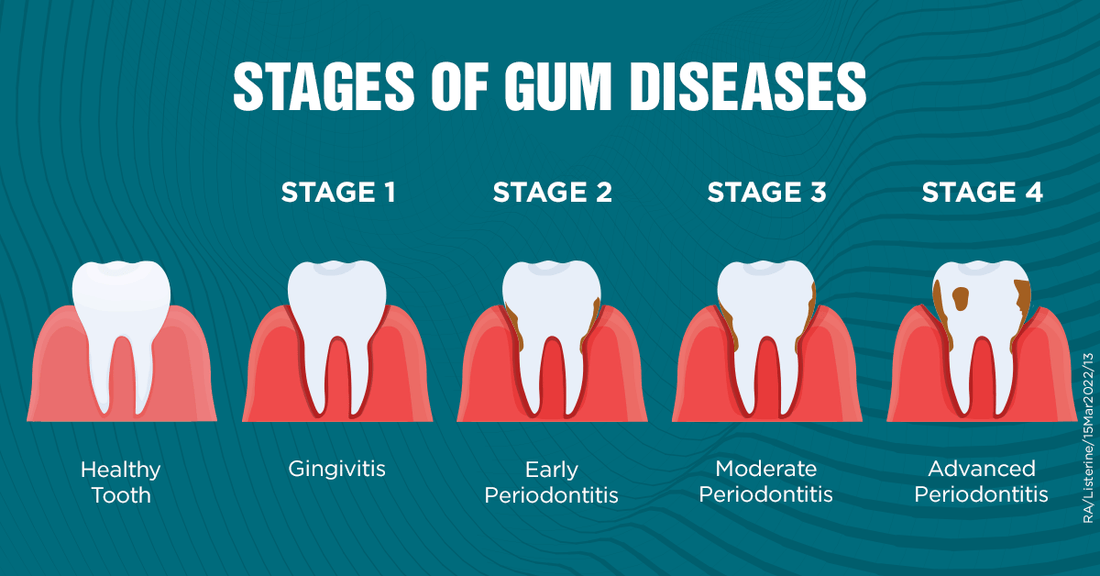 What are the stages of gingivitis?
