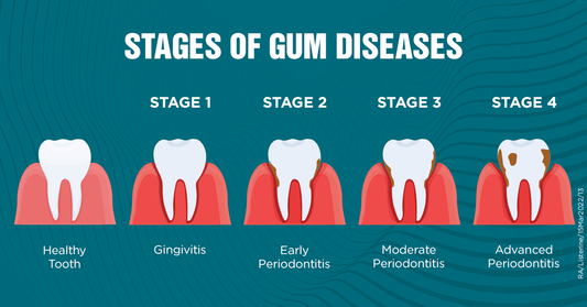 What are the stages of gingivitis?