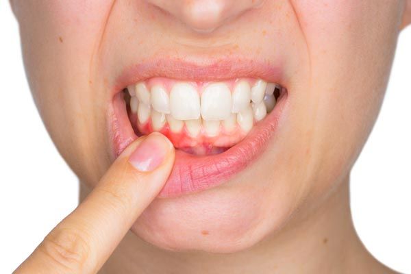  Why are my gums peeling?