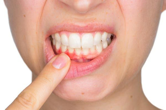  Why are my gums peeling?
