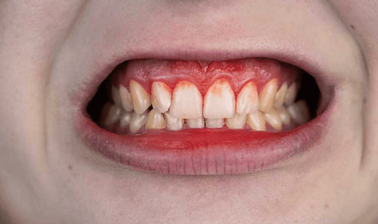 How to treat a gum infection without antibiotics.