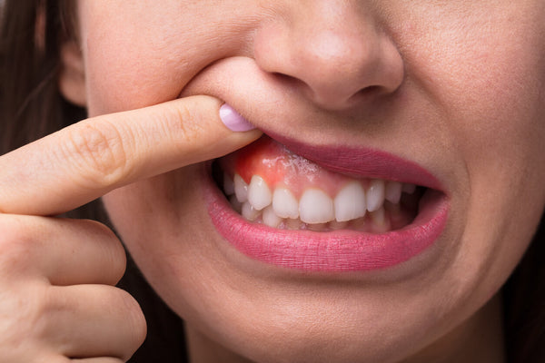 How to treat burned gums from teeth whitening.