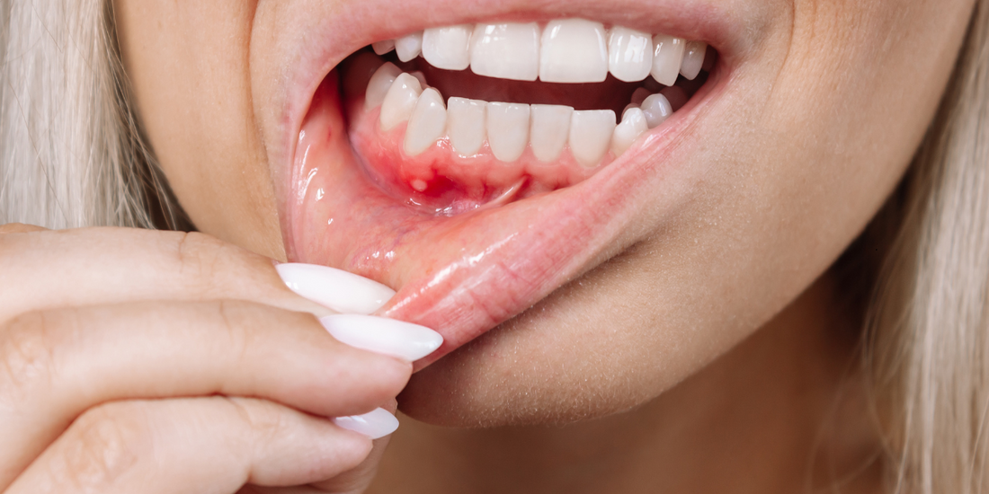 What is gum erosion?