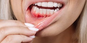 What Is Gum Erosion: The Complete Guide to Understanding And Treating Them